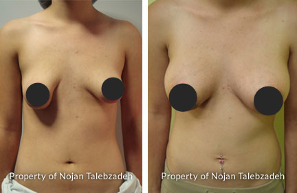 Correction Of Tubular Breast